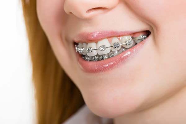 Dental Care with Braces