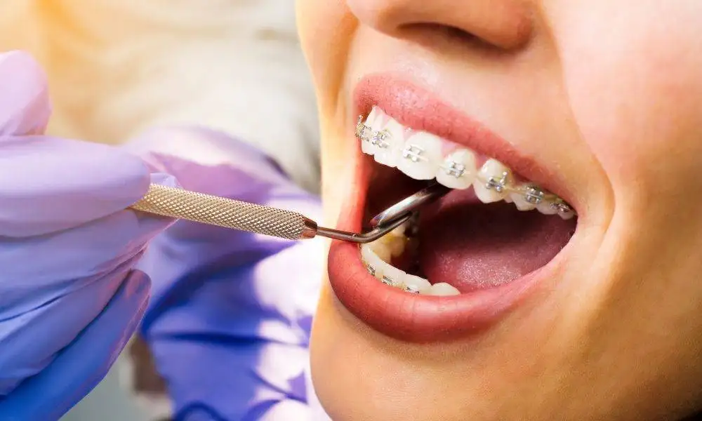 Dental Care with Braces