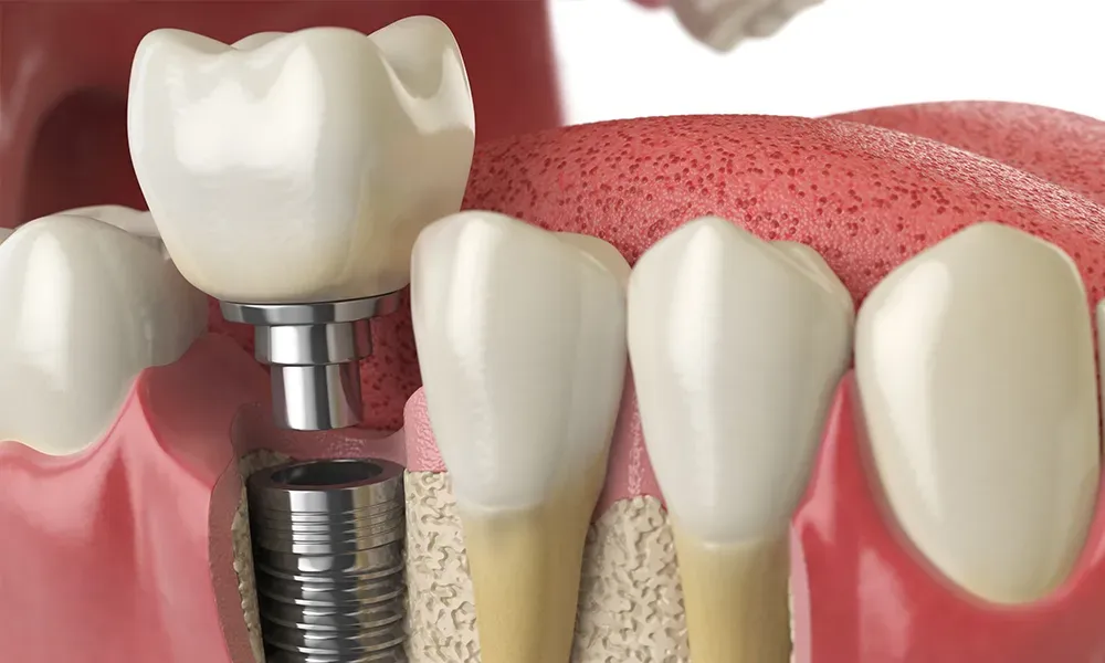 Dental Implants: A Comprehensive Guide to Types and Materials