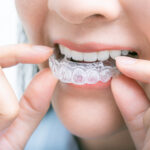 Invisalign Treatment