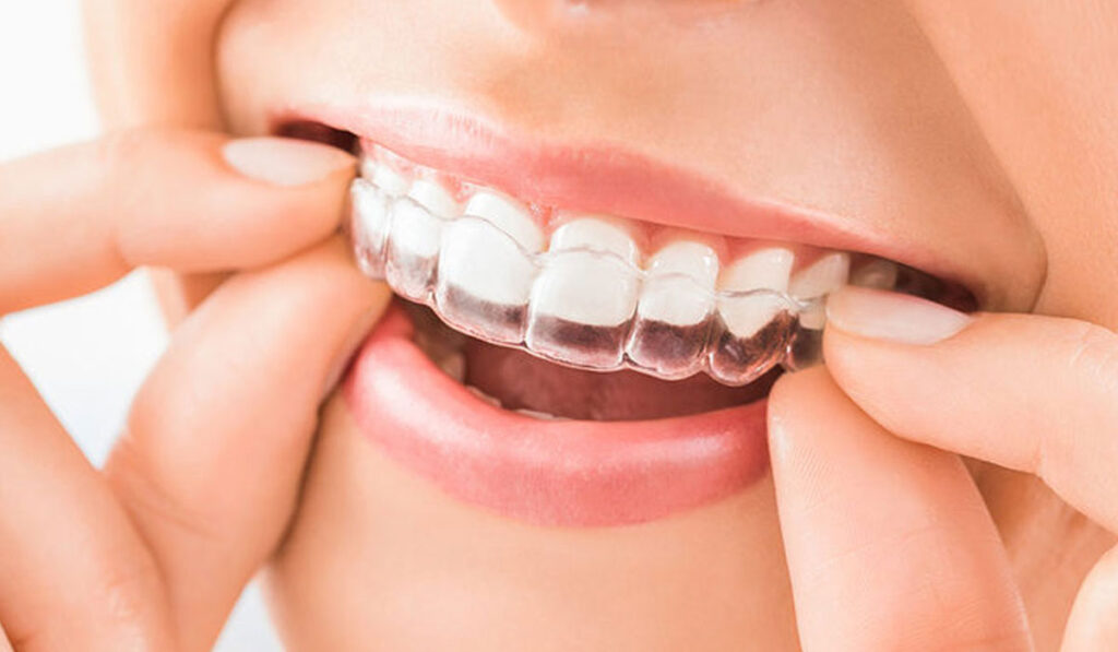 Traditional Braces vs. Clear Aligners in South San Jose: Which Option is Best for You?